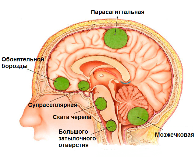 Менингиома