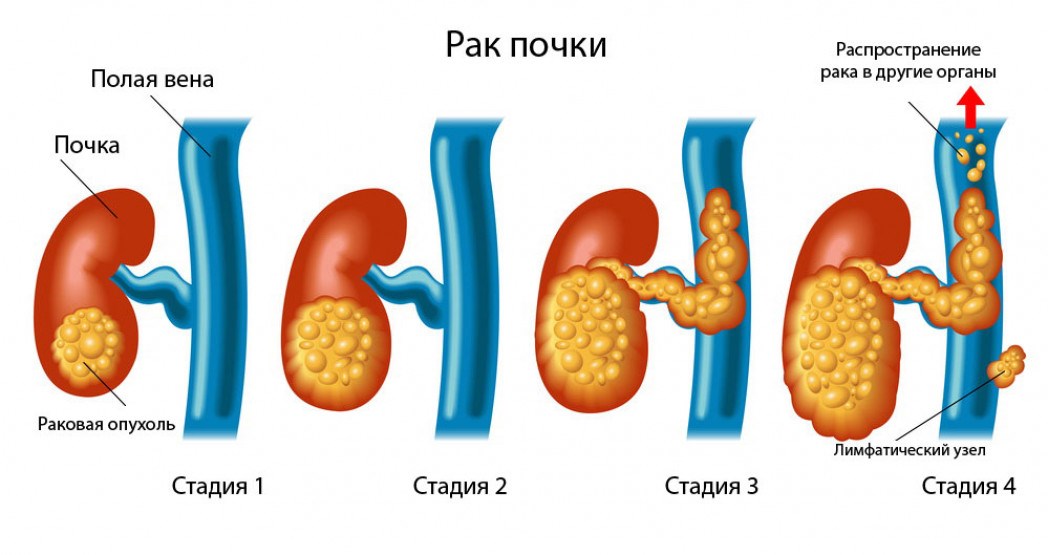 Рак почки