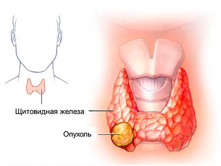 рак щитовидной железы