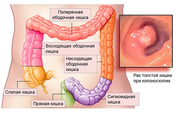 Рак толстой кишки